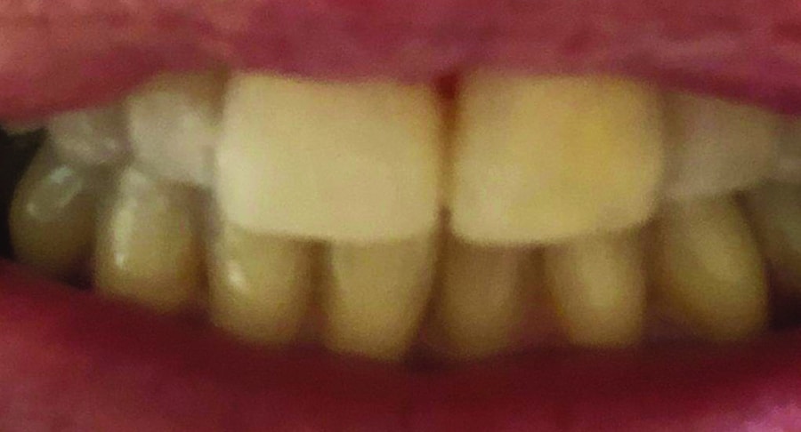 Smile Case 6 Northpointe Smiles dentist in Tomball Texas Dr. Neelima Samineni