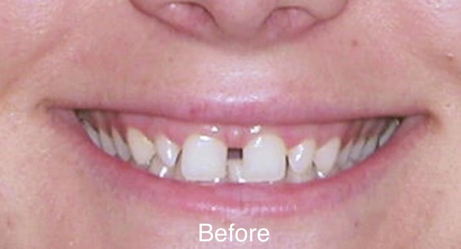Smile Case 4 Northpointe Smiles in Tomball Northpointe Smiles dentist in Tomball Texas Dr. Neelima Samineni