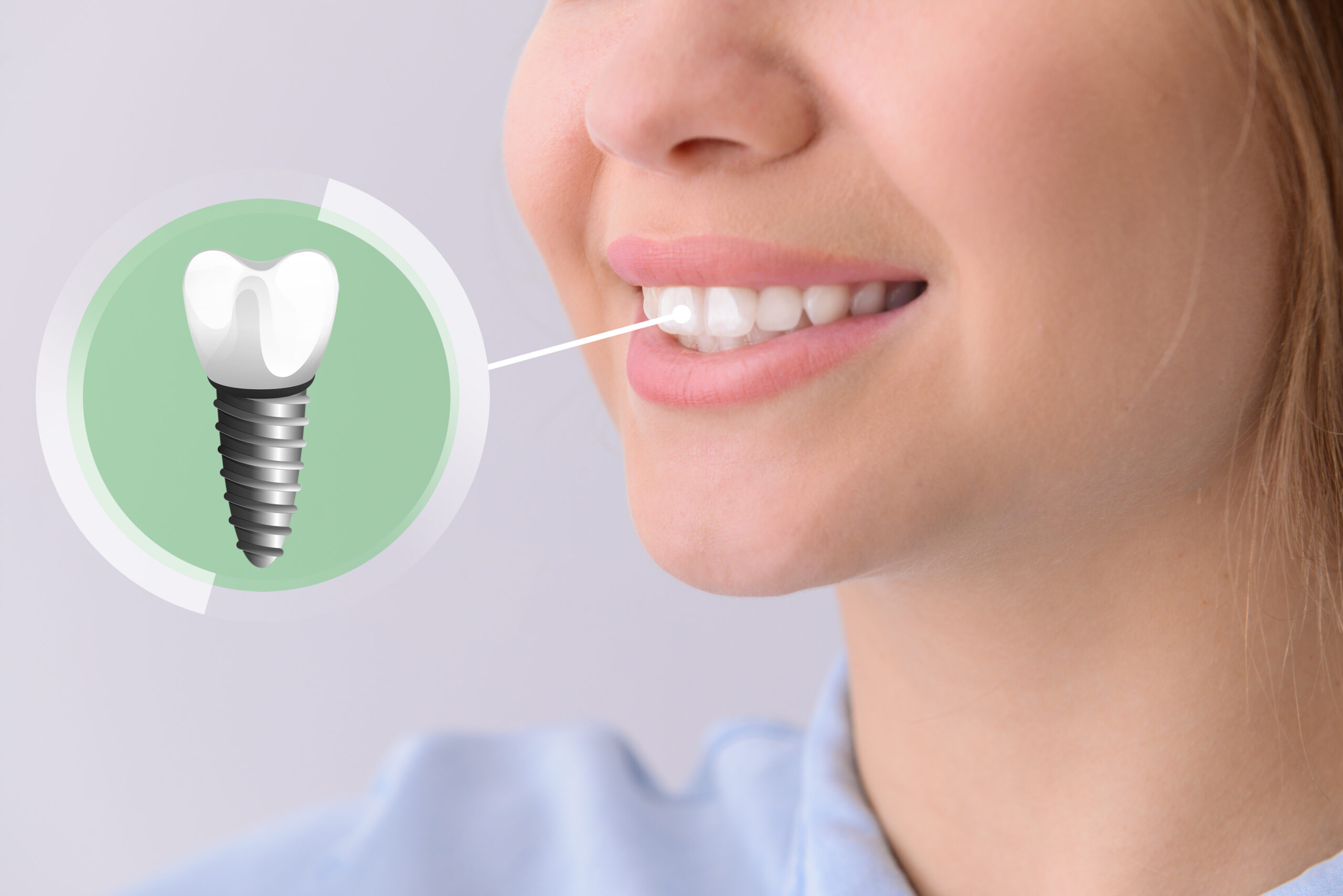 everything-you-need-to-know-about-dental-implants-northpointe-smiles